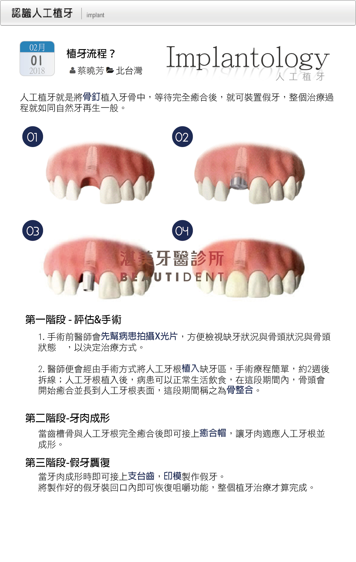 种植牙手术过程详解六步走 - 知乎